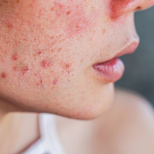 Acne Treatments at Best Skin Clinic in Fareham, Hampshire