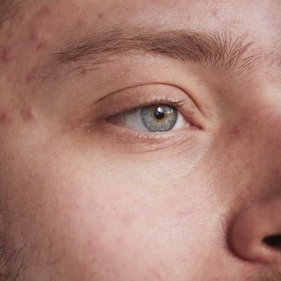acne treatments at k:SPA in Solent Business Park, Fareham