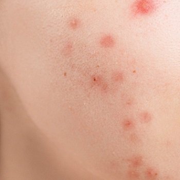 acne treatments at k:SPA in Fareham