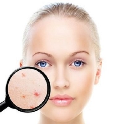 How To Tackle Adult Acne