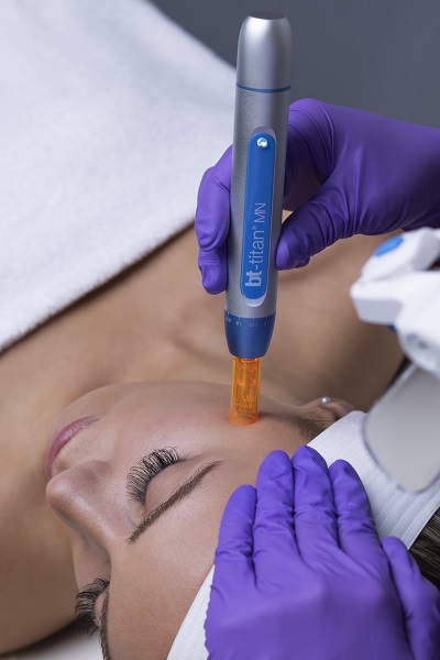Microneedling