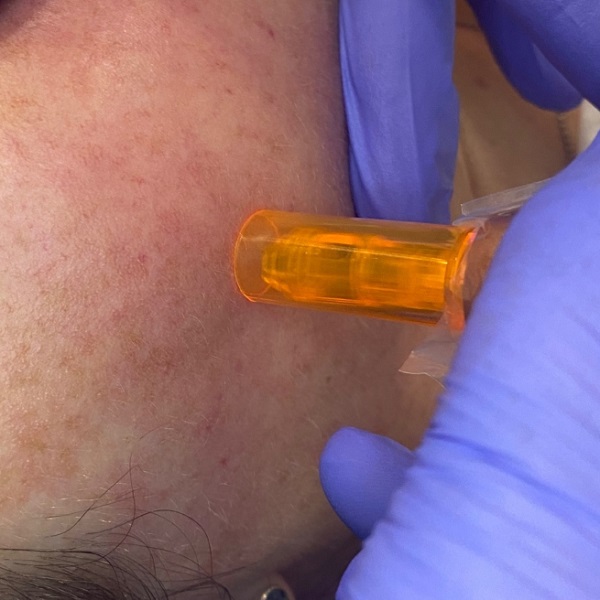 BT-Titan Microneedling at best beauty salon in Fareham BT-Titan Microneedling at best beauty salon in Fareham