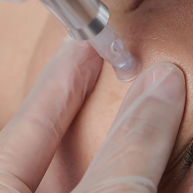 microneedling at k:SPA in Solent Business Park, Fareham microneedling at k:SPA in Solent Business Park, Fareham