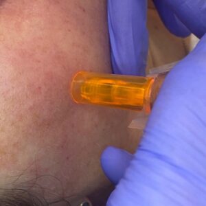 bt titan microneedling at kSPA in Fareham