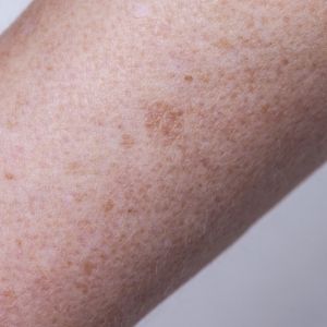 hyperpigmentation treatments at k:SPA in Solent Business Park, Fareham hyperpigmentation treatments at k:SPA in Solent Business Park, Fareham