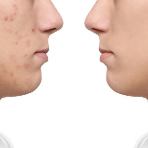 Hyperpigmentation Treatments at Best Skin Clinic in Fareham, Hampshire Hyperpigmentation Treatments at Best Skin Clinic in Fareham, Hampshire