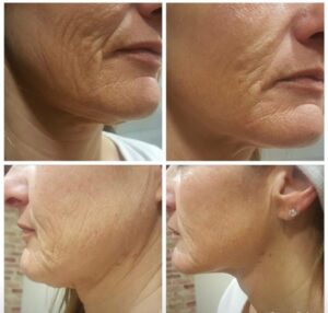 Copy of Cryo face