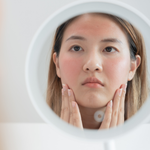 Top Tips To Combat Rosacea