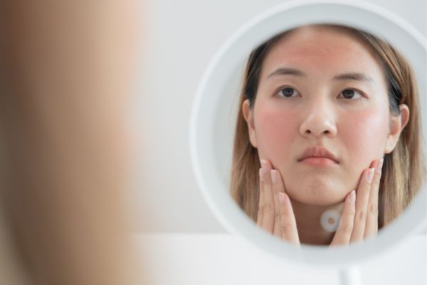 rosacea treatments in Fareham