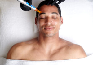 Deonte MicroNeedling Professional Treatment Photos